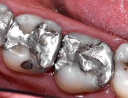 Amalgamfüllungen biologische Zahnmedizin