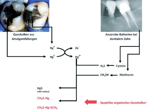 Quecksilberdampf aus Amalgamfüllungen kann in Verbindung mit bakteriellen Biotoxinen zu hochgiftigen Supertoxinen (Dimethylquecksilber) mutieren.