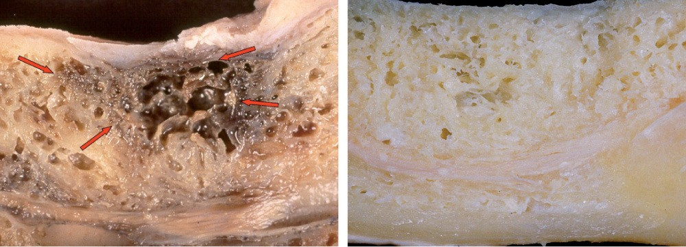 Biologische Zahnmedizin: Kranker vs. gesunder Knochen (Photo: J Oral Pathol Med 1999; 28:423.)