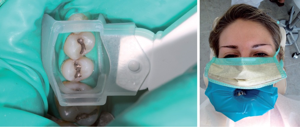 Biologische Zahnmedizin: Schutzmaßnahmen bei der professionellen Amalgamentfernung. Kofferdamm – Goldnasenmaske – Clean-Up Sauger. Nicht im Bild: Sauerstoff- Nasensonde.