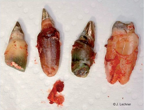 Biologische Zahnmedizin: Wurzelbehandelte Zähne