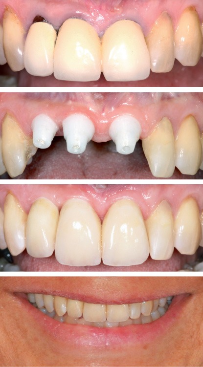 Keramikimplantate: Before&After: Extraktion, Implantation und definitive Kronen