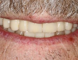 Biologische Zahnmedizin Keramikimplantate