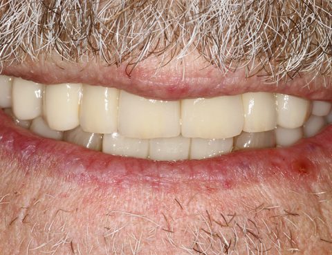 Biologische Zahnmedizin Keramikimplantate