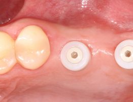 Keramikimplantate biologische Zahnmedizin