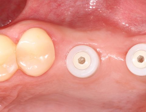Keramikimplantate biologische Zahnmedizin