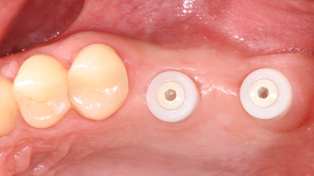 Keramikimplantate biologische Zahnmedizin