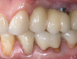 Biologische Zahnmedizin elektromagnetische Felder Keramikimplantate