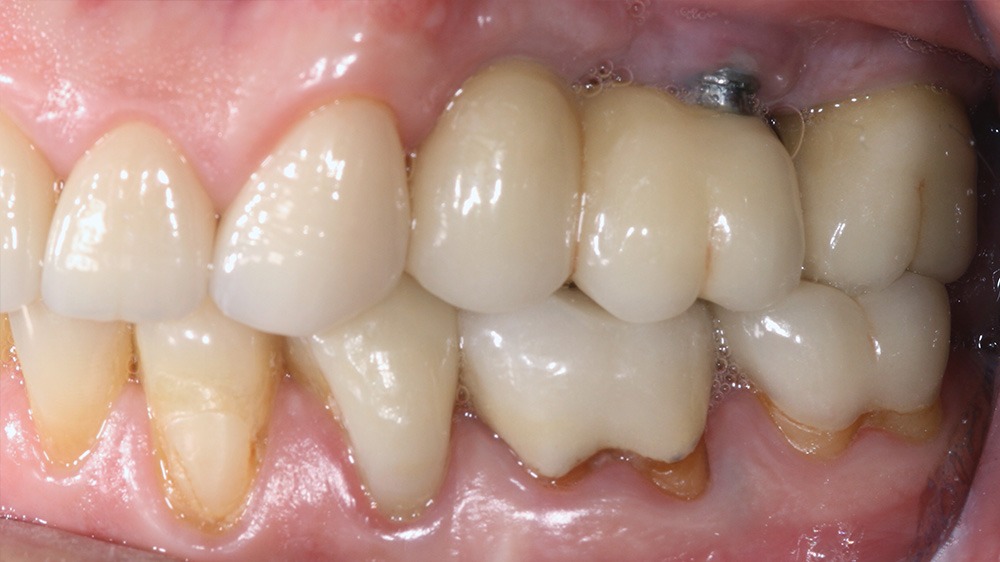 Biologische Zahnmedizin elektromagnetische Felder Keramikimplantate